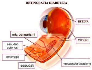 retinopatia-diabetica2