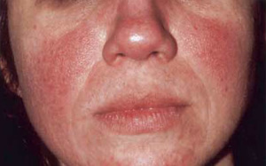 rosacea2